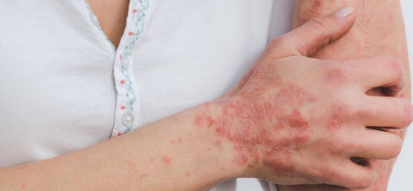 best and worst foods for psoriasis