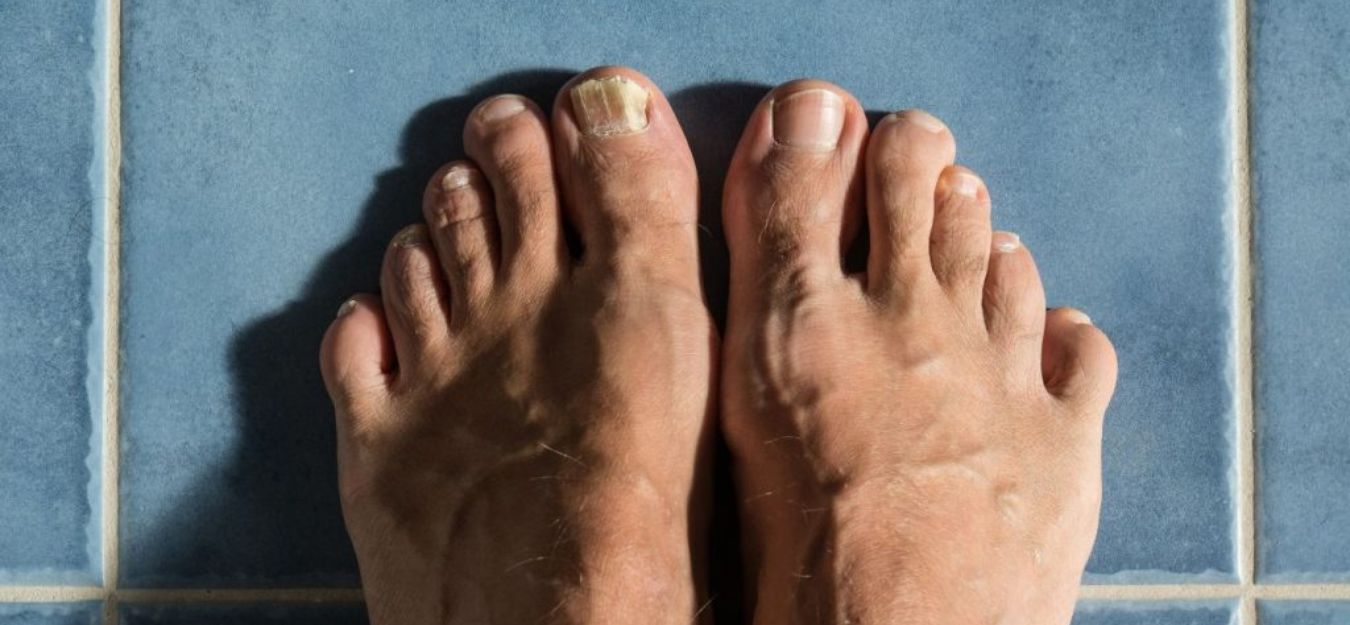 how to get rid of nail fungus