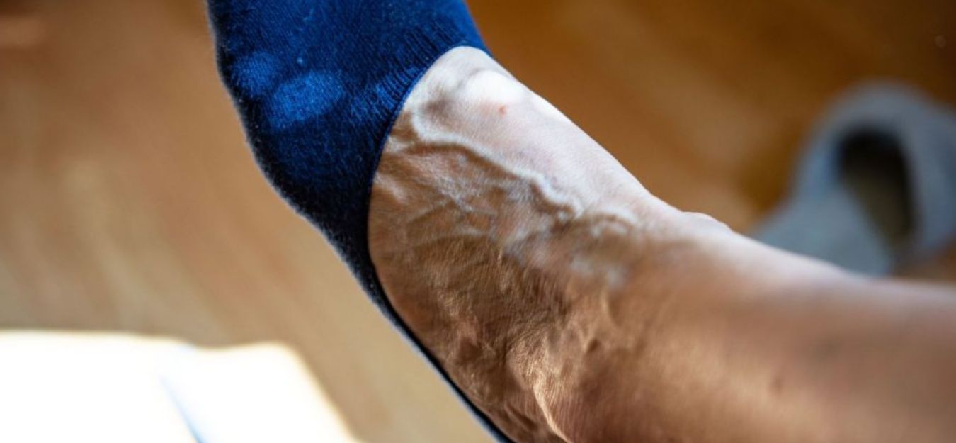 varicose veins cancer symptoms