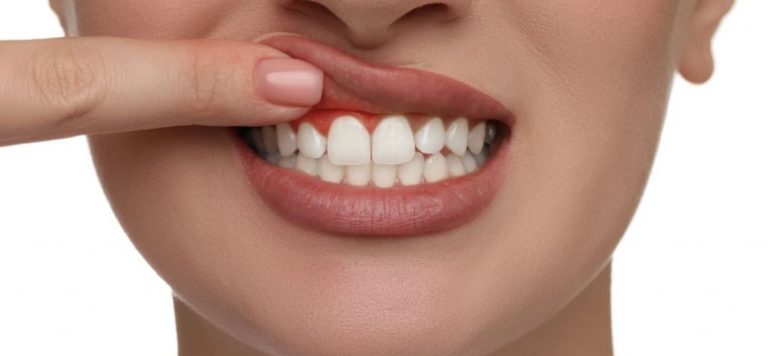 how to cure gum disease without a dentist