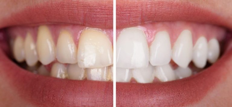 teeth whitening sensitive teeth